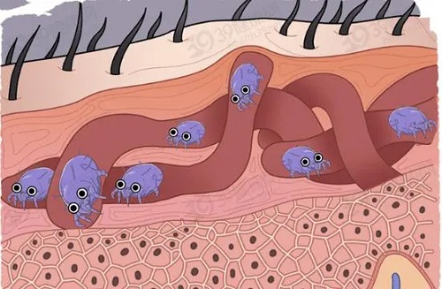 疥疮的初期症状是什么 疥疮怎么治疗呢