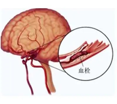 怎样预防脑血栓 脑血栓的形成原因是什么