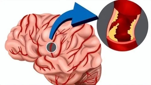 怎样预防脑血栓 脑血栓有什么征兆