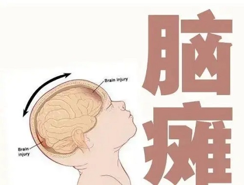 脑瘫能治愈吗 孩子脑瘫什么时候治疗最佳