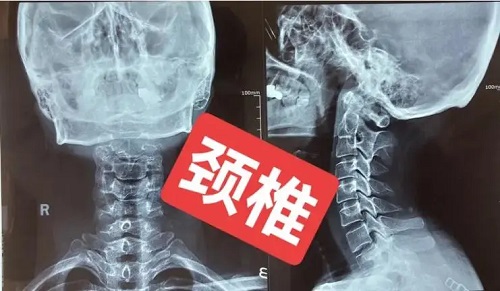 如何预防颈椎病 颈椎病头晕怎么办