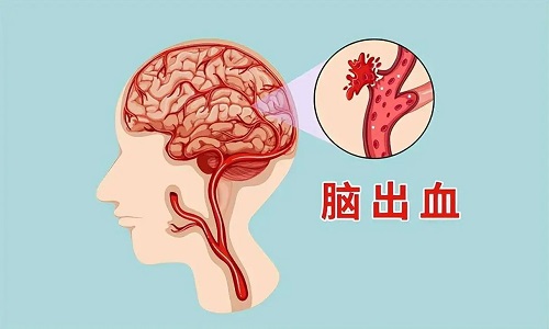 脑出血前有8个征兆是什么 如何防护高血压脑出血