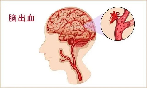 脑出血前有8个征兆是什么 脑出血吃什么药膳进补最好