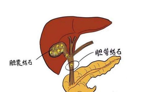 胆结石最怕三个蔬菜是什么 胆结石如何治疗最好