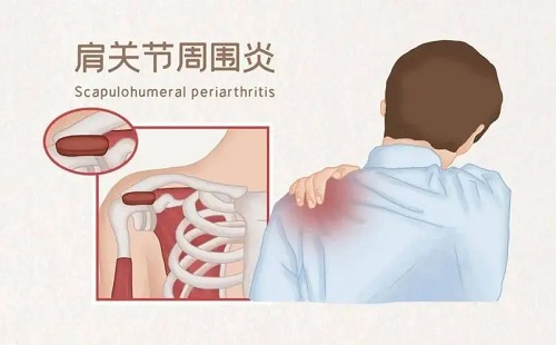 肩周炎的锻炼方法有哪些 白领患有肩周炎怎么办