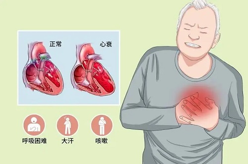 心衰的6个早期信号是什么 心衰能治好吗