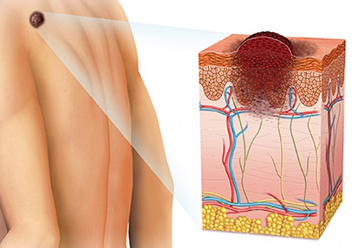 什么是黑色素瘤 黑色素瘤早期有什么症状