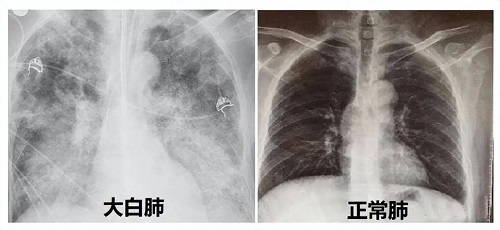 大白肺能治好吗 大白肺的症状是什么样