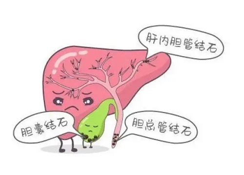 胆管结石吃什么药 胆管结石是什么原因引起的