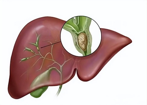 胆管结石吃什么药 胆管结石的手术风险大吗